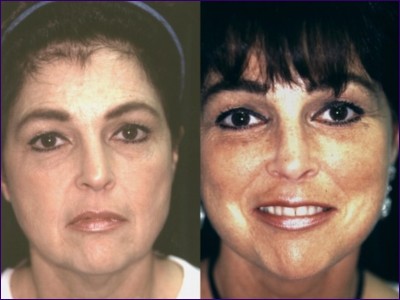 Linda Briggs - Before and  after surgery with Prof Yousif