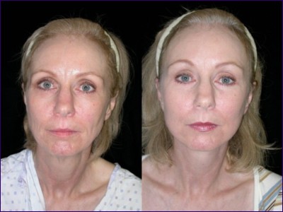 Linda Briggs - Front view of face before and after surgery