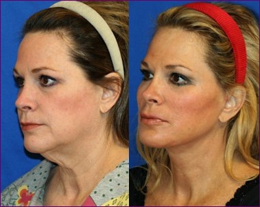 Linda Briggs - patients before and after face lift pictures