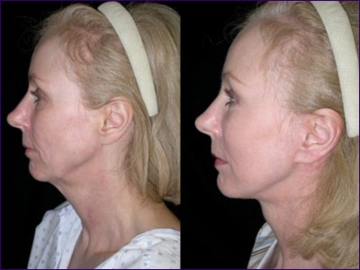 Linda Briggs - Before and after surgery with Prof Yousif, side view