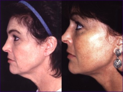 Linda Briggs - Before and after surgery, side view