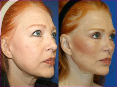 Linda Briggs - a patient before and after face lifting